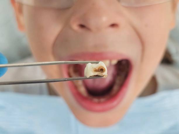 Best Emergency Dentist for Knocked-Out Tooth in Burton, MI