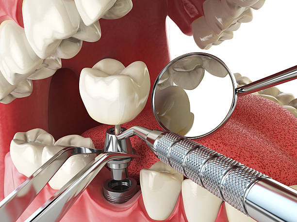 Best Emergency Dentist for Lost Fillings or Crowns in Burton, MI